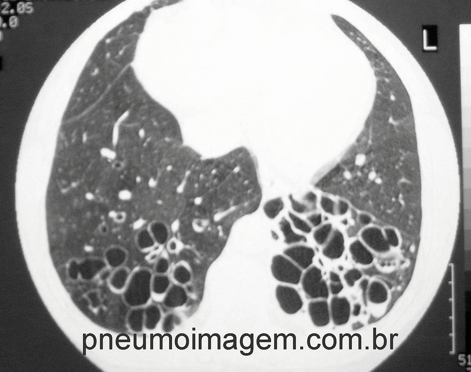 DESTAQUES DO ERS2016: MICROBIOMA PULMONAR